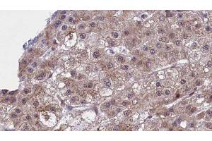 ABIN6277451 at 1/100 staining Human liver cancer tissue by IHC-P.