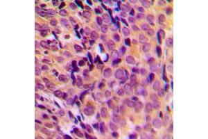 Immunohistochemical analysis of MRPL17 staining in human breast cancer formalin fixed paraffin embedded tissue section. (MRPL17 抗体  (C-Term))