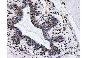 Immunohistochemical staining of paraffin-embedded breast tissue using anti-IFT57 mouse monoclonal antibody. (IFT57 抗体)