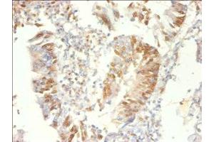 Immunohistochemistry of paraffin-embedded human colon cancer using ABIN7164919 at dilution of 1:100 (PSME3 抗体  (AA 2-252))