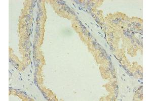 Immunohistochemistry of paraffin-embedded human prostate cancer using ABIN7158804 at dilution of 1:100 (LAMP2 抗体  (AA 54-268))