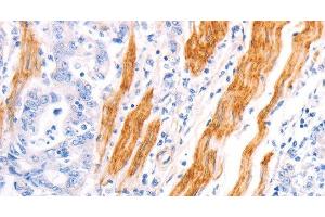 Immunohistochemistry of paraffin-embedded Human gastric cancer using TPM1 Polyclonal Antibody at dilution of 1:40 (Tropomyosin 抗体)