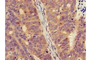 Immunohistochemistry of paraffin-embedded human colon cancer using ABIN7160758 at dilution of 1:100 (FPR3 抗体  (AA 307-353))