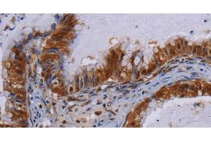 Immunohistochemistry of paraffin-embedded Human esophagus cancer using MECP2 Polyclonal Antibody at dilution of 1:60 (MECP2 抗体)