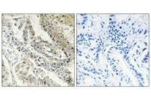 Immunohistochemistry analysis of paraffin-embedded human lung carcinoma tissue, using CRBP III antibody. (Retinol Binding Protein 5 抗体)