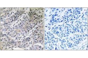 Immunohistochemistry analysis of paraffin-embedded human lung carcinoma tissue, using BRP44 Antibody. (BRP44 抗体  (AA 31-80))