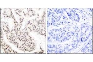 Immunohistochemistry analysis of paraffin-embedded human breast carcinoma, using Elk1 (Phospho-Thr417) Antibody. (ELK1 抗体  (pThr417))