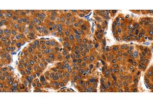 Immunohistochemistry of paraffin-embedded Human liver cancer using HSP75 Polyclonal Antibody at dilution of 1:100 (TRAP1 抗体)