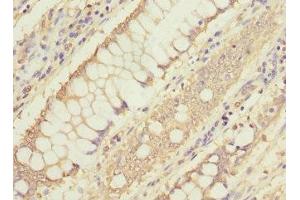 Immunohistochemistry of paraffin-embedded human colon cancer using ABIN7160191 at dilution of 1:100 (MTHFD1L 抗体  (AA 759-978))