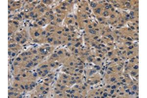 The image on the left is immunohistochemistry of paraffin-embedded Human liver cancer tissue using ABIN7191127(ITGA11 Antibody) at dilution 1/40, on the right is treated with synthetic peptide.