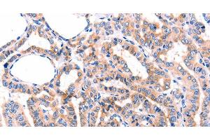Immunohistochemistry of paraffin-embedded Human thyroid cancer tissue using GRK2 Polyclonal Antibody at dilution 1:87 (GRK2 抗体)