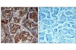 Immunohistochemical analysis of paraffin-embedded human Lung carcinoma tissue using mTOR (Ab-2448) Antibody (E021214). (MTOR 抗体)