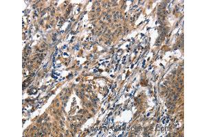 Immunohistochemistry of Human liver cancer using ALOX15 Polyclonal Antibody at dilution of 1:50 (ALOX15 抗体)