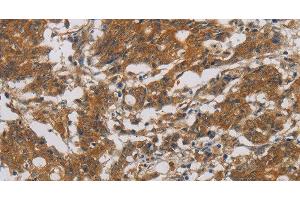 Immunohistochemistry of paraffin-embedded Human gastic cancer using CNDP1 Polyclonal Antibody at dilution of 1:30 (CNDP1 抗体)