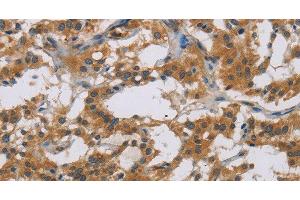 Immunohistochemistry of paraffin-embedded Human thyroid cancer tissue using IL18R1 Polyclonal Antibody at dilution 1:40 (IL18R1 抗体)