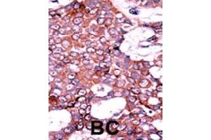 Formalin-fixed and paraffin-embedded human cancer tissue reacted with CDC25A (phospho S75) polyclonal antibody  which was peroxidase-conjugated to the secondary antibody followed by AEC staining. (CDC25A 抗体  (pSer76))