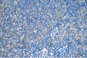 Immunohistochemistry was performed on paraffin-embedded human lymphoma using LC3B antibody (ABIN7799410), 1:200). (Recombinant LC3B 抗体)