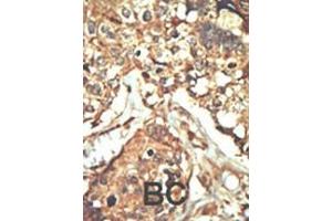 Formalin-fixed and paraffin-embedded human cancer tissue reacted with the primary antibody, which was peroxidase-conjugated to the secondary antibody, followed by AEC staining. (PRKDC 抗体  (C-Term))