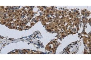 Immunohistochemistry of paraffin-embedded Human breast cancer using PRKAR1B Polyclonal Antibody at dilution of 1:70