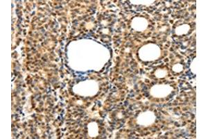 The image on the left is immunohistochemistry of paraffin-embedded Human thyroid cancer tissue using ABIN7131276(SYT7 Antibody) at dilution 1/15, on the right is treated with fusion protein. (SYT7 抗体)
