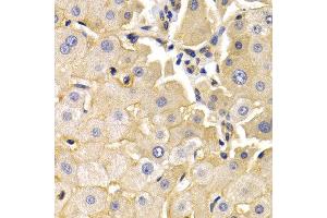 Immunohistochemistry of paraffin-embedded human liver cancer using KLKB1 antibody at dilution of 1:200 (400x lens). (KLKB1 抗体)