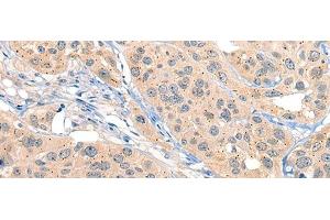 Immunohistochemistry of paraffin-embedded Human esophagus cancer tissue using MIIP Polyclonal Antibody at dilution of 1:45(x200) (MIIP 抗体)