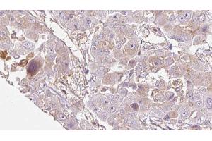 ABIN6272714 at 1/100 staining Human liver cancer tissue by IHC-P. (OR1E1 抗体  (C-Term))