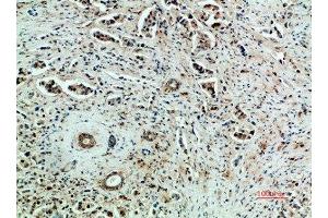 Immunohistochemical analysis of paraffin-embedded human-breast-cancer, antibody was diluted at 1:200 (VEGFR2/CD309 抗体  (AA 1268-1341))