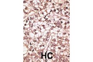 Formalin-fixed and paraffin-embedded human cancer tissue reacted with the primary antibody, which was peroxidase-conjugated to the secondary antibody, followed by AEC staining. (ABCB4 抗体  (AA 624-654))