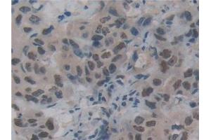 Detection of DFFa in Human Breast cancer Tissue using Polyclonal Antibody to DNA Fragmentation Factor Subunit Alpha (DFFa)