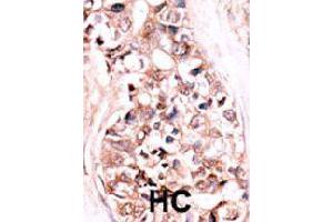Formalin-fixed and paraffin-embedded human hepatocellular carcinoma tissue reacted with DUSP14 polyclonal antibody  , which was peroxidase-conjugated to the secondary antibody, followed by AEC staining. (DUSP14 抗体  (N-Term))