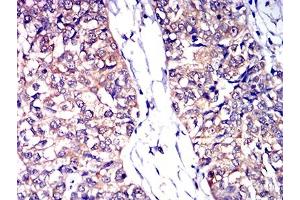 Immunohistochemical analysis of paraffin-embedded bladder cancer tissues using CD53 mouse mAb with DAB staining. (CD53 抗体)