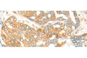 Immunohistochemistry of paraffin-embedded Human liver cancer tissue using CFHR2 Polyclonal Antibody at dilution of 1:35(x200) (CFHR2 抗体)