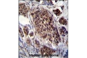 FRAT2 Antibody (C-term) (ABIN655793 and ABIN2845223) immunohistochemistry analysis in formalin fixed and paraffin embedded human bladder carcinoma followed by peroxidase conjugation of the secondary antibody and DAB staining. (FRAT2 抗体  (C-Term))