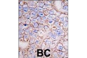 Formalin-fixed and paraffin-embedded human breast carcinoma tissue reacted with ERK8 antibody (N-term) (ABIN391796 and ABIN2841651) , which was peroxidase-conjugated to the secondary antibody, followed by DAB staining. (MAPK15 抗体  (N-Term))