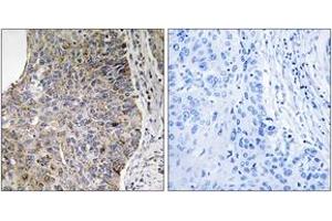 Immunohistochemistry analysis of paraffin-embedded human lung carcinoma tissue, using NEK7 Antibody. (NEK7 抗体  (AA 101-150))
