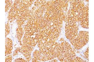 Formalin-fixed, paraffin-embedded human Renal Cell Carcinoma stained with RCC Monoclonal Antibody (SPM314). (CA9 抗体)