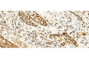 Immunohistochemistry of paraffin-embedded Human esophagus cancer tissue using METTL1 Polyclonal Antibody at dilution of 1:50(x200) (METTL1 抗体)