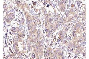 ABIN6277438 at 1/100 staining Human breast cancer tissue by IHC-P. (TPM2 抗体  (C-Term))