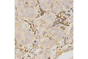 Immunohistochemistry of paraffin-embedded human liver cancer using KLK5 antibody (ABIN5971539) at dilution of 1/200 (40x lens). (Kallikrein 5 抗体)