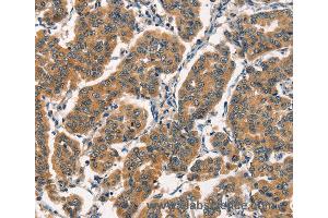 Immunohistochemistry of Human breast cancer using ARL6IP1 Polyclonal Antibody at dilution of 1:30 (ARL6IP1 抗体)