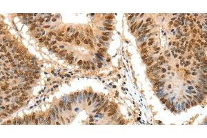 Immunohistochemistry of paraffin-embedded Human colon cancer tissue using SSB Polyclonal Antibody at dilution 1:50 (SSB 抗体)