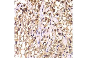 Immunohistochemistry of paraffin-embedded human kidney cancer using TCEB3 antibody. (TCEB3 抗体)