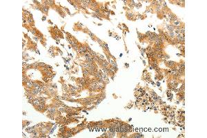 Immunohistochemistry of Human gastric cancer using RARRES1 Polyclonal Antibody at dilution of 1:60 (RARRES1 抗体)