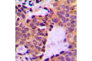 Immunohistochemical analysis of Cortactin (pY466) staining in human breast cancer formalin fixed paraffin embedded tissue section. (Cortactin 抗体  (C-Term, pTyr466))