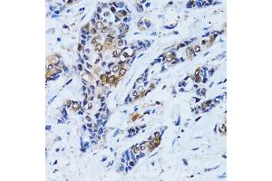 Immunohistochemistry of paraffin-embedded human breast cancer using IMPA1 antibody (ABIN2563424) at dilution of 1:100 (40x lens). (IMPA1 抗体)