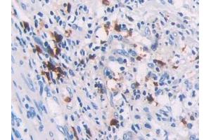 DAB staining on IHC-P; Samples: Human Colorectal cancer Tissue (RHOQ 抗体  (AA 1-202))