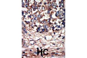 Formalin-fixed and paraffin-embedded human hepatocellular carcinoma tissue reacted with NEK9 polyclonal antibody  , which was peroxidase-conjugated to the secondary antibody, followed by AEC staining. (NEK9 抗体  (C-Term))