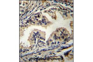 STBP Antibody (C-term) (ABIN656627 and ABIN2845873) immunohistochemistry analysis in formalin fixed and paraffin embedded human prostate carcinoma followed by peroxidase conjugation of the secondary antibody and DAB staining. (STAMBP 抗体  (C-Term))