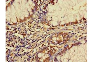 Immunohistochemistry of paraffin-embedded human colon cancer using ABIN7152491 at dilution of 1:100 (FBXW12 抗体  (AA 1-250))